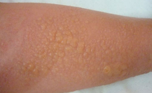 Cánh tay bị phổng rộp sau khi lột da tắm trắng Cánh tay bị phổng rộp sau khi lột da tắm trắng