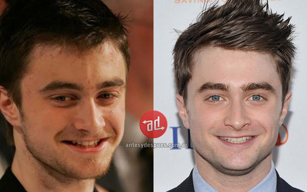 Daniel Radcliffe Daniel Radcliffe