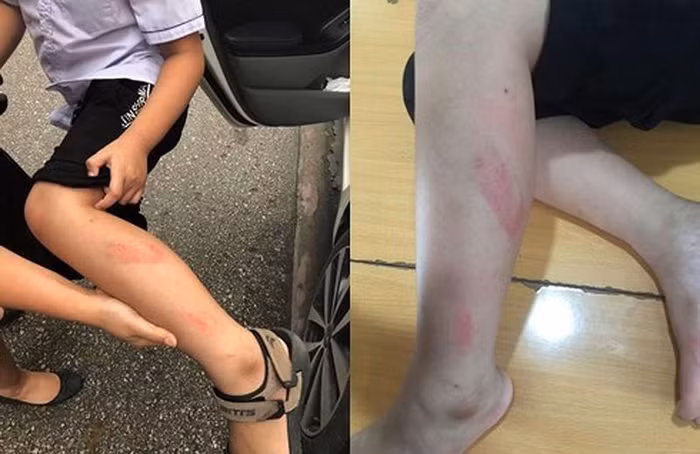 Chân học sinh bị cô giáo Nguyễn Thị Thu Trang đánh sưng tấy trong giờ kiểm tra học kỳ 2 (Ảnh: Gia đình cung cấp)