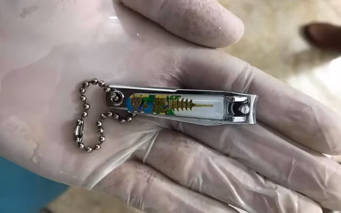 Hình ảnh chiếc bấm móng tay mà bé gái nuốt vào bụng do học theo video trên mạng (Ảnh: Báo điện tử VTV)