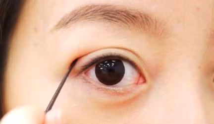 Để có được đôi mắt to tròn nhiều chị em đã không ngần ngại sử dụng các 'chiêu' làm đẹp... mạo hiểm