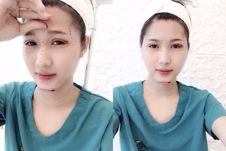 Nguyễn Văn Hiếu từng gây xôn xao cộng đồng mạng khi công khai ảnh phẫu thuật thẩm mỹ chuyển giới thành hot girl.