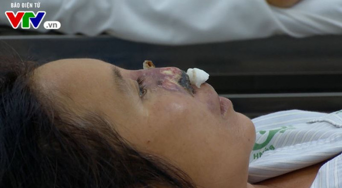 Bệnh nhân mắc bệnh Whitmore (Ảnh minh họa: vtv.vn). Bệnh nhân mắc bệnh Whitmore (Ảnh minh họa: vtv.vn).