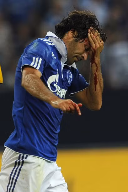 Huyền thoại của Real Madrid và đội tuyển Tây Ban Nha dính chấn thương nặng ở vùng đầu sau pha va chạm.