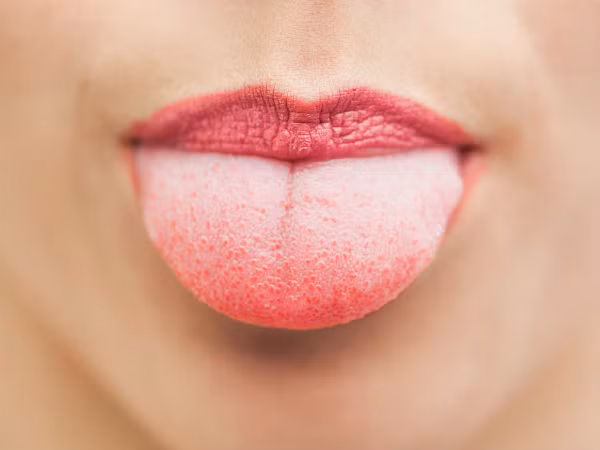 Ngay cả lưỡi cũng chứa vi khuẩn (Ảnh: theo boldsky).