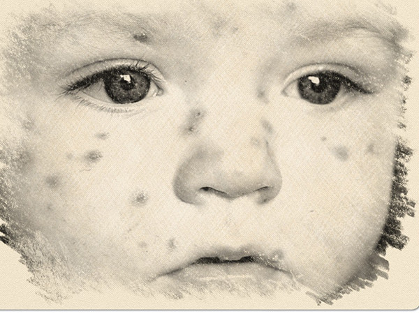 Rubella hay còn được gọi là sởi Đức (Ảnh: theo Boldsky). Rubella hay còn được gọi là sởi Đức (Ảnh: theo Boldsky).