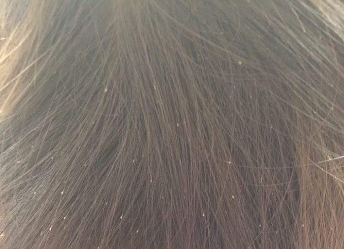 Chấy và trứng chấy rất nhiều trên tóc các bé. Chấy và trứng chấy rất nhiều trên tóc các bé.