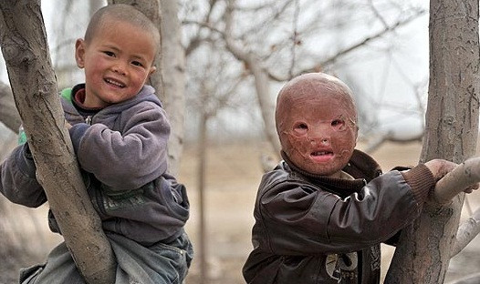 Wang Xiaopeng không có tóc, môi, mí mắt và ngón tay sau tai nạn kinh hoàng. Wang Xiaopeng không có tóc, môi, mí mắt và ngón tay sau tai nạn kinh hoàng.