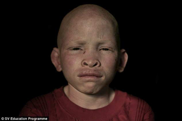 Trẻ mắc bệnh bạch tạng ở Tanzania không được đến trường và sống bình thường vì bị kỳ thị và đe dọa tấn công. Trẻ mắc bệnh bạch tạng ở Tanzania không được đến trường và sống bình thường vì bị kỳ thị và đe dọa tấn công.