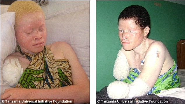 Nhiều người Tanzania giàu có mê tín sẵn sàng trả số tiền lên tới 3.000 USD hoặc 4.000 USD cho một cánh tay hoặc chân của người bạch tạng. Nhiều người Tanzania giàu có mê tín sẵn sàng trả số tiền lên tới 3.000 USD hoặc 4.000 USD cho một cánh tay hoặc chân của người bạch tạng.