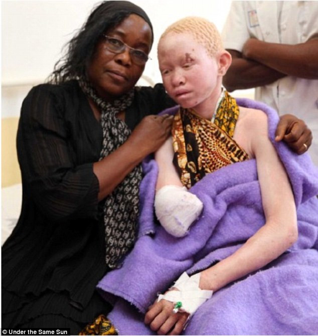 Pendo Sengerema, 15 tuổi, bị tấn công chặt mất tay phải hồi năm 2014. Pendo Sengerema, 15 tuổi, bị tấn công chặt mất tay phải hồi năm 2014.