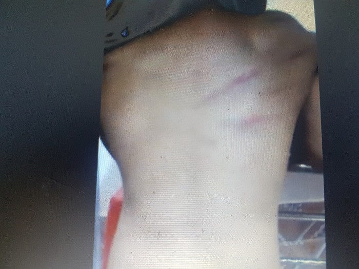 Vết bầm trên lưng cháu Ngh. Vết bầm trên lưng cháu Ngh.