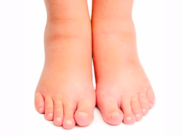 Phù nề gây ra gây ra cảm giác sưng và khó chịu (Ảnh: theo boldsky). Phù nề gây ra gây ra cảm giác sưng và khó chịu (Ảnh: theo boldsky).