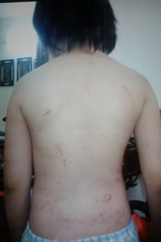Những vết thương dày đặc trên lưng bé trai 10 tuổi ở Hà Nội, do bị bố đẻ và mẹ kế bạo hành nhiều năm liền. Và trên gương mặt thơ dại của bé cũng còn rất nhiều vết sẹo do bị đánh đập. Bé trai này không được đi học, phải nằm ngủ dưới sàn đất, ăn mì tôm khô, bánh mỳ khô và cơm nguội. Những vết thương dày đặc trên lưng bé trai 10 tuổi ở Hà Nội, do bị bố đẻ và mẹ kế bạo hành nhiều năm liền. Và trên gương mặt thơ dại của bé cũng còn rất nhiều vết sẹo do bị đánh đập. Bé trai này không được đi học, phải nằm ngủ dưới sàn đất, ăn mì tôm khô, bánh mỳ khô và cơm nguội.