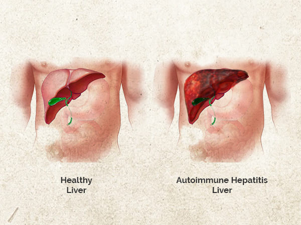 Viêm gan tự miễn gây viêm gan (Ảnh: theo boldsky). Viêm gan tự miễn gây viêm gan (Ảnh: theo boldsky).