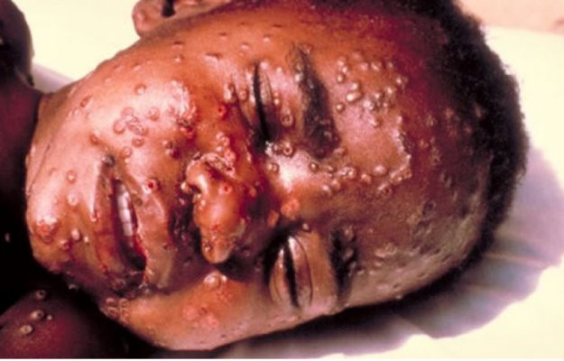 WHO cảnh báo nguy cơ Ebola bùng phát và lây lan nhanh ở Đông Nam Á là rất lớn. Ảnh minh họa, nguồn internet. WHO cảnh báo nguy cơ Ebola bùng phát và lây lan nhanh ở Đông Nam Á là rất lớn. Ảnh minh họa, nguồn internet.