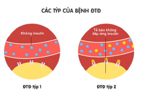 Các týp của bệnh đái tháo đường.