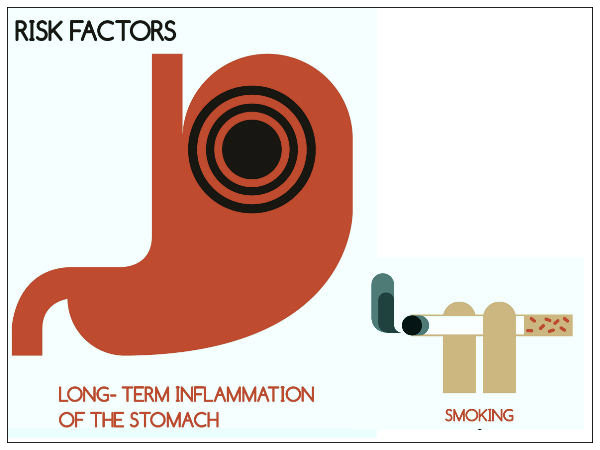 Hút thuốc lá gây hại cho hệ thống tiêu hóa(Ảnh: theo boldsky). Hút thuốc lá gây hại cho hệ thống tiêu hóa(Ảnh: theo boldsky).