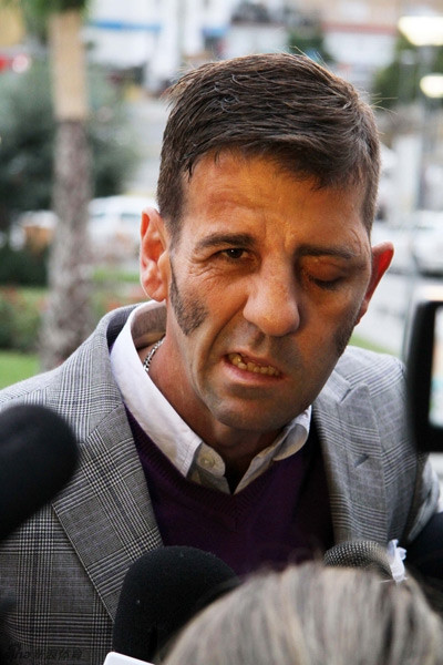 Đã khỏe mạnh trở lại nhưng Juan Jose Padilla trở thành người chột.