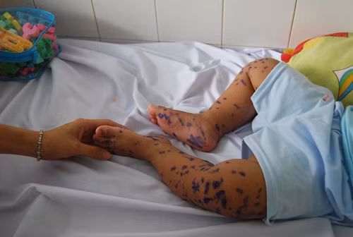 Nhiều loại bệnh truyền nhiễm dễ bùng phát vào mùa mưa. ảnh: Báo Thanh niên.