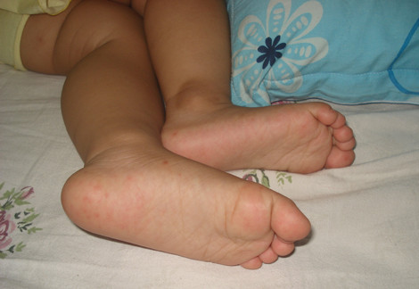 Các nốt đỏ trên chân con gái chị Lý đã mất dần (Ảnh do chị Lý cung cấp) Các nốt đỏ trên chân con gái chị Lý đã mất dần (Ảnh do chị Lý cung cấp)