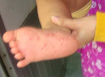 Số ca mắc bệnh TCM năm 2011 cao cấp 10 lần năm trước