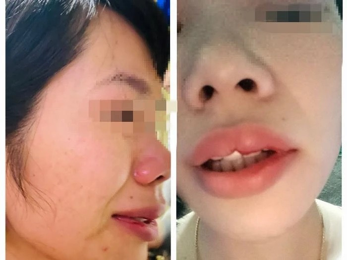 Cô Q. bị thương nhiều vị trí sau khi bị ông L.M.D. tấn công. Ảnh minh họa: Báo Đăk Nông Cô Q. bị thương nhiều vị trí sau khi bị ông L.M.D. tấn công. Ảnh minh họa: Báo Đăk Nông