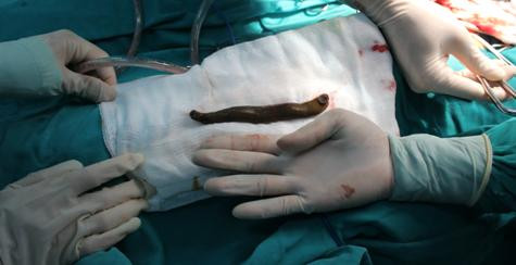 Con Đỉa dài gần 20cm được các bác sĩ lấy ra từ bàng quang của cháu Lâm Con Đỉa dài gần 20cm được các bác sĩ lấy ra từ bàng quang của cháu Lâm