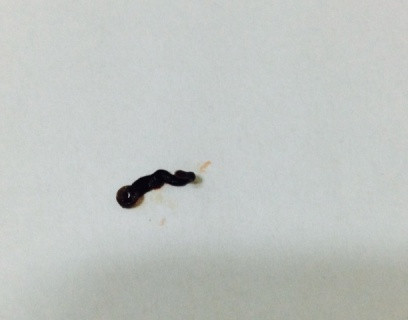 Con vắt dài 4cm to bằng ngón tay út được gắp từ mắt bệnh nhân (ảnh do bác sĩ bệnh viện cung cấp) Con vắt dài 4cm to bằng ngón tay út được gắp từ mắt bệnh nhân (ảnh do bác sĩ bệnh viện cung cấp)