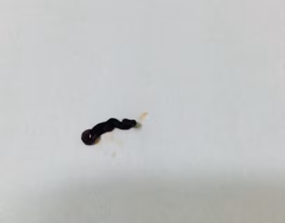 Con vắt dài 4cm to bằng ngón tay út được gắp từ mắt bệnh nhân (ảnh do bác sĩ bệnh viện cung cấp)