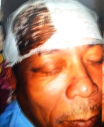 Ông Lê Văn Toàn bị các đối tượng lạ mặt đánh đến chấn động sọ não Ông Lê Văn Toàn bị các đối tượng lạ mặt đánh đến chấn động sọ não