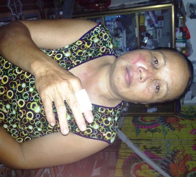 Bà Sâm bị tổ trưởng tổ an ninh trật tự đánh bầm tím mặt Bà Sâm bị tổ trưởng tổ an ninh trật tự đánh bầm tím mặt