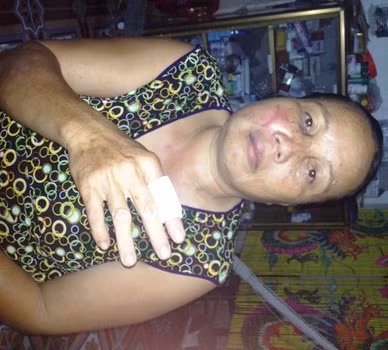 Bà Sâm bị tổ trưởng tổ an ninh trật tự đánh bầm tím mặt