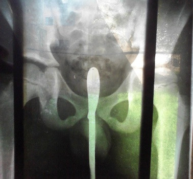 Hình ảnh chụp X - quang cho thấy thanh thép 6 nằm sâu trong hậu môn bé trai Hình ảnh chụp X - quang cho thấy thanh thép 6 nằm sâu trong hậu môn bé trai