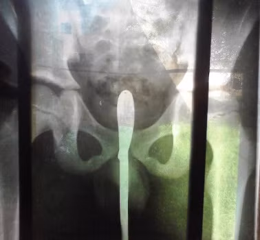 Hình ảnh chụp X - quang cho thấy thanh thép 6 nằm sâu trong hậu môn bé trai
