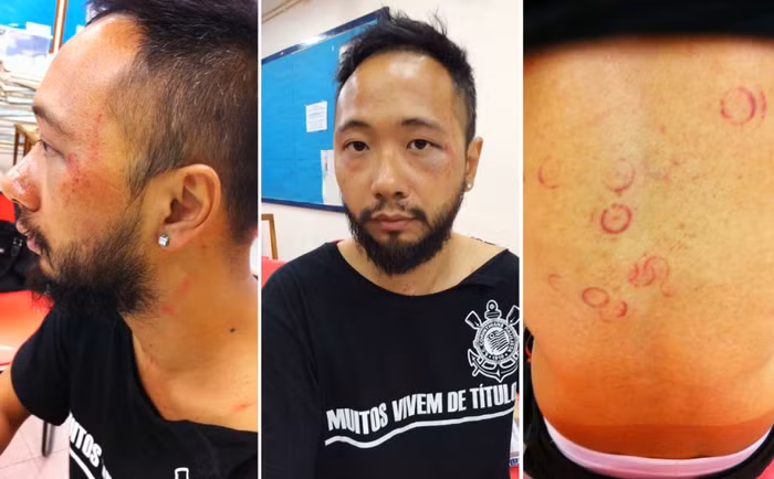 Tsang và những vết thương trên cơ thể sau khi bị cảnh sát đánh đập. Tsang và những vết thương trên cơ thể sau khi bị cảnh sát đánh đập.