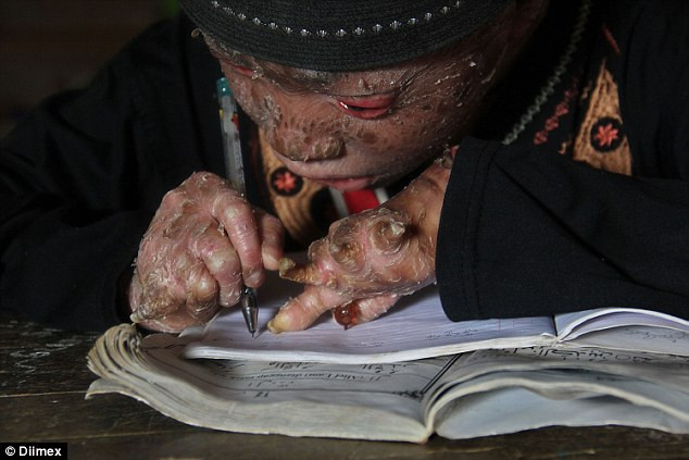 Ari với tình trạng viêm da hiếm gặp. Ari với tình trạng viêm da hiếm gặp.