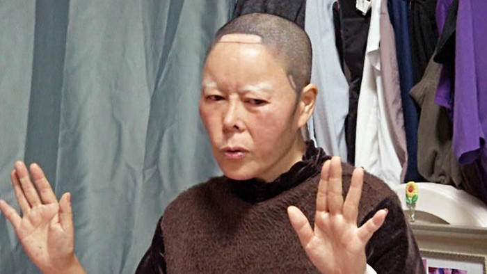 Khuôn mặt biến dạng của Kim Bok-soon sau ca phẫu thuật hỏng. Khuôn mặt biến dạng của Kim Bok-soon sau ca phẫu thuật hỏng.