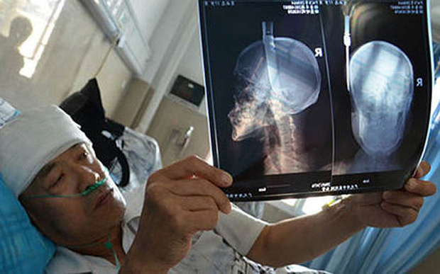 Ông Xiao và tấm phim chụp x-quang hình ảnh con dao cắm vào đầu ông. Ông Xiao và tấm phim chụp x-quang hình ảnh con dao cắm vào đầu ông.