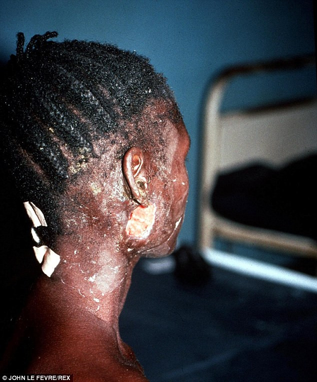 Cơ thể bị virus Ebola tàn phán của một bệnh nhân. Cơ thể bị virus Ebola tàn phán của một bệnh nhân.