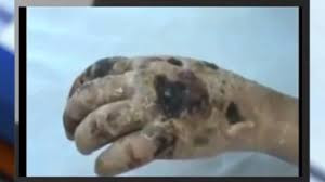 Cơ thể người nghiện bị ma túy ăn mòn. Cơ thể người nghiện bị ma túy ăn mòn.