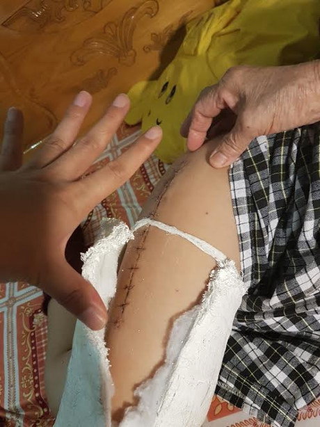 Chân của bé Kiên sau khi được phẫu thuật. ảnh: vtc. Chân của bé Kiên sau khi được phẫu thuật. ảnh: vtc.