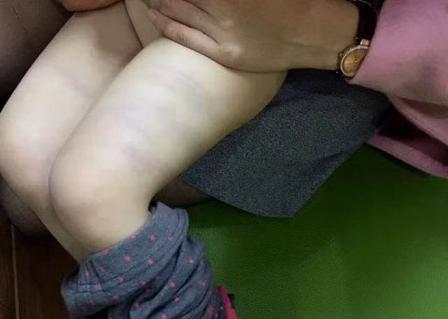 Học sinh 3 tuổi trường Ngọc Sơn bị đánh bầm tím ở lớp học ảnh 1