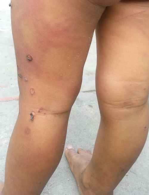 Dấu vết của những lần cháu bị cậu và cậu họ chích thuốc lá Dấu vết của những lần cháu bị cậu và cậu họ chích thuốc lá