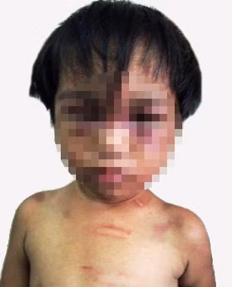 Bé Đức và dấu vết của lần bị bạo hành gần nhất