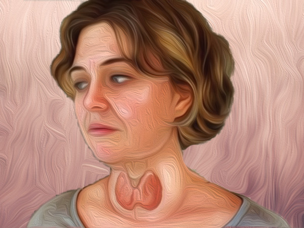 Các biện pháp khắc phục tuyệt vời và hiệu quả cho bệnh bướu cổ (Ảnh: theo Boldsky).