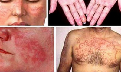 Bảo hiểm xã hội tháo gỡ vướng mắc trong thanh toán thuốc điều trị Lupus ban đỏ. ảnh trên Sức khỏe đời sống.