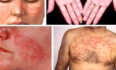 Bảo hiểm xã hội tháo gỡ vướng mắc trong thanh toán thuốc điều trị Lupus ban đỏ. ảnh trên Sức khỏe đời sống.