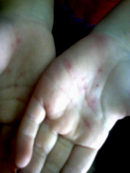 Bàn tay bị đâm kim của cháu Tuệ