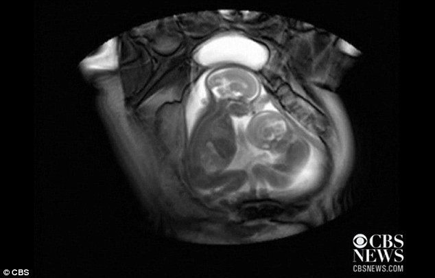 Em bé lớn hơn phản ứng lại bằng cách cử động cơ hàm. Em bé lớn hơn phản ứng lại bằng cách cử động cơ hàm.